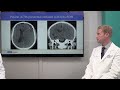 MMA Embolization: An Emerging Treatment Technique for Chronic Subdural Hematomas | UCLA Health