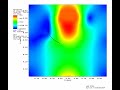 Tricuspid Leaflet Velocity 6/7/20