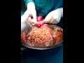 Removing intestinal worms