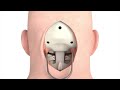 Craniectomy brain surgery - 3D animation