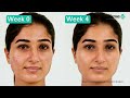 The Derma Co | Sali-Cinamide Serum for Acne & Acne Marks