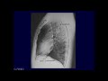 Chest X-ray: Introduction and Approach