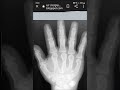 technician x-ray hand wrist, findings very interesting!!