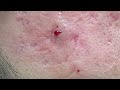 Acne treatment for Spa Linh Mun 2024 #107