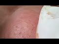 The best acne squeezing collection form Linh Mun Spa part 20