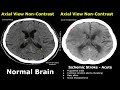 CT Scan Brain Normal Vs Ischemic Stroke Images | Non-Contrast Hyperacute/Acute/Chronic Infarction