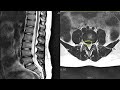 MRI 상 디스크가 탈출되었으면 재활치료가 안되는가?