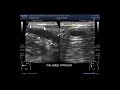 Ultrasound Video showing the technique to localize the Inflamed Appendix.