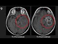 Introduction to MRI of the brain