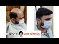 Non Surgical Hair Replacement in Bangalore | 9951223066