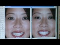 How do braces work?- Jenison MI Orthodontist