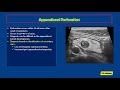 Ultrasound of Acute Appendicitis: Pearls and Pitfalls
