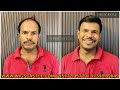 Best Hair Solution | Permanent Hair Loss Solution | Stop Hair Loss | Treatment for Hair Loss