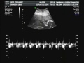 Baby Sophia - Ultrasound 18w5d Part 2