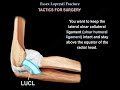 Fracture Of The Radial Head Essex Lopresti - Everything You Need To Know - Dr. Nabil Ebraheim