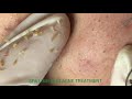 Acne treatment for Loc Ha Long part 1 | Spa Linh Mun Acne Treatment