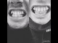 3 Months Progress #braces #adultbraces