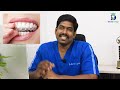 உங்கள் கேள்விகள் S1 E4 : How much will Clip Treatment Cost | பல்லுல கிளிப் போட எவ்வளவு செலவாகும் ?