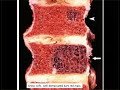 Spine lecture hemangioma of spine