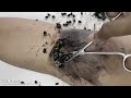 Cleaning ticks on human feet #069