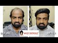 Hair Fixing in Bangalore | 8247798712 | 9951223066