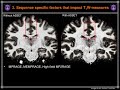 Summer Course 2018: 23 Imaging Changes in Brain Anatomy by Cibu Thomas