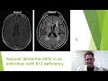 B12 Deficiency and Neurological Disease  [Explained by Neurologist]