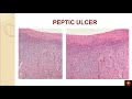 Peptic ulcer disease - Dr.V.Shanthi