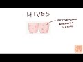 Urticaria | Dermatology (Pathophysiology,clinical features,diagnosis,treatment) MedVidsMadeSimple