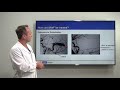 Brain Arteriovenous Fistula: Diagnosis and Treatment | Viktor Szeder, MD, PhD | UCLAMDChat