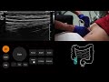 Ultrasound Tutorial: Appendix/Appendicitis | Radiology Nation
