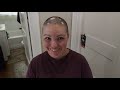 My Journey with Alopecia.