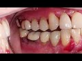 3 Reasons Your Gums Are Inflamed and How to Treat at Home 🦷🔥