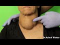 Examination of Thyroid - Surgery - Prof. Ashraf Khater