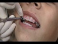 Patient Question: How are colored ties put on clear braces?