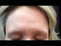 Spectacular Results  Instantly Ageless ➽Video Proof Removes Forehead Lines