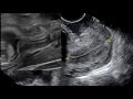 Pyloric Ultrasound