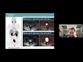 Recurrent Prostate Cancer Cases - 2021 Prostate Cancer Patient Conference