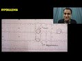 HYPOKALEMIA TREATMENT GUIDELINES, SYMPTOMS, MANAGEMENT, ECG CHANGES, POTTASSIUM REPLACEMENT PROTOCOL