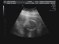 Baby Sophia - Ultrasound 18w5d Part 3