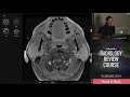 Bilateral Parotid Diseases - Radiology Review Course (MRI, CT, ultrasound)