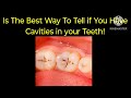 How to know if you have Cavities between teeth