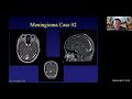 Treatment of Meningiomas - A Panel Discussion with Dr. David Park and Dr. Amid Persad