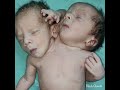 Genetic Abnormalities Baby | A Baby Born with 2 Heads & 3 Hands | 2 தலை, 3 கைகளுடன் பிறந்த குழந்தை !