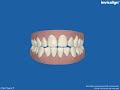 Invisalign teeth simulation