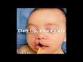 Cleft lip and nose repair