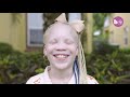 My Twin Sister Has Albinism | BORN DIFFERENT