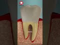 Root Canal Treatment 3D Animation #shorts