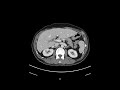 Anatomy of CT scans: Abdomen