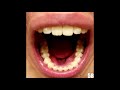 Invisalign Full Time-lapse